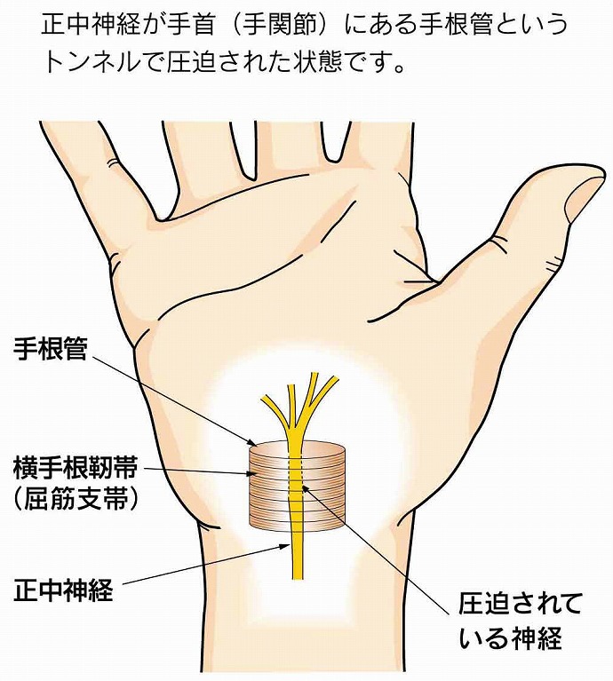 管 症候群 根 手