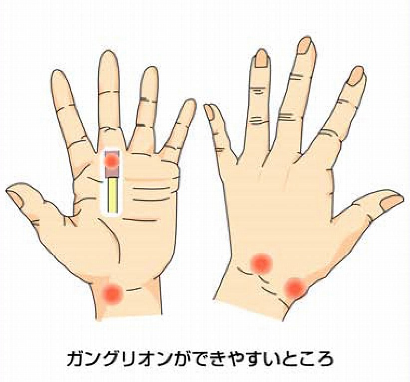 しこり 足 の 甲 ガングリオンとは｜自然治癒する？悪性腫瘍との見分け方は？