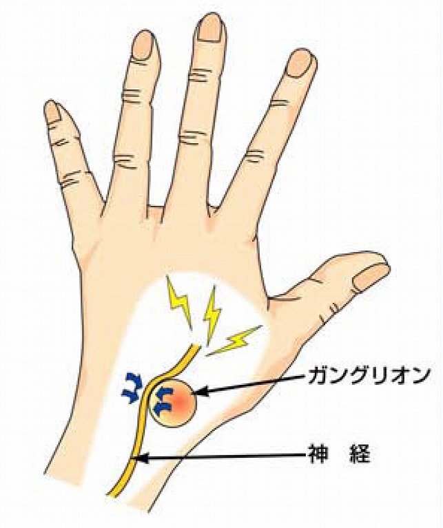 ガングリオンの症状 原因 治療法について 神奈川県藤沢市の池上整形外科