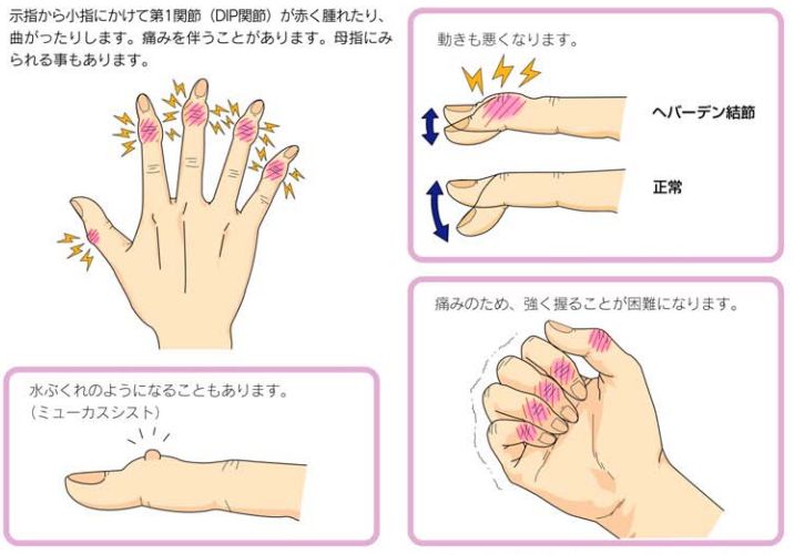 指 の 関節 の 痛み