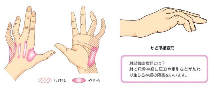 肘部管症候群 指 手のしびれ の症状 原因 治療法について 神奈川県藤沢市の池上整形外科
