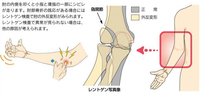 ストレッチ 管 症候群 肘 部 手根管症候群の治療～手術～ストレッチ～サポーター～リハビリ・全知識