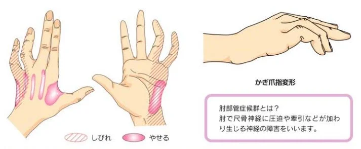 肘部管症候群の症状