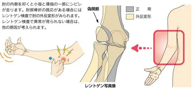 肘部管症候群の診断