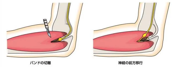 肘部管症候群の予防と治療