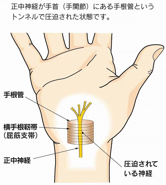 手根管症候群