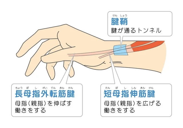 ド・ケルバン病